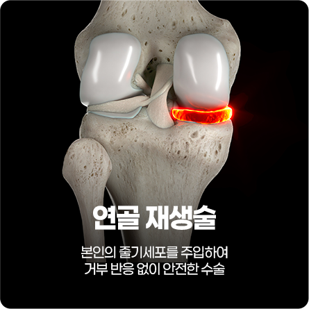 연골 재생술