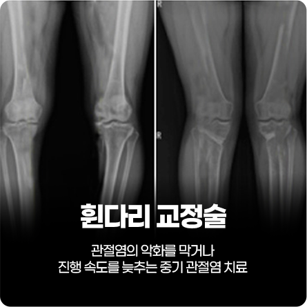 휜다리 교정술