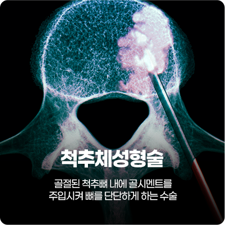 척추체성형술
