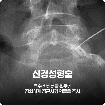 신경성형술