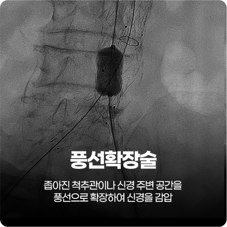 풍선확장술술